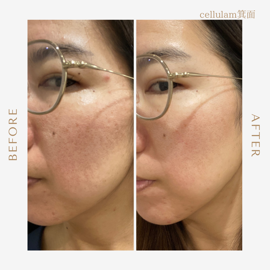 箕面のエステサロンセルラムフェイシャルケア・ビフォアー/アフターNO.2