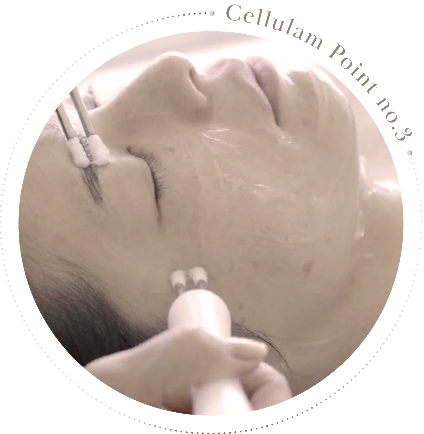 リフティング/リフトアップの施術イメージ