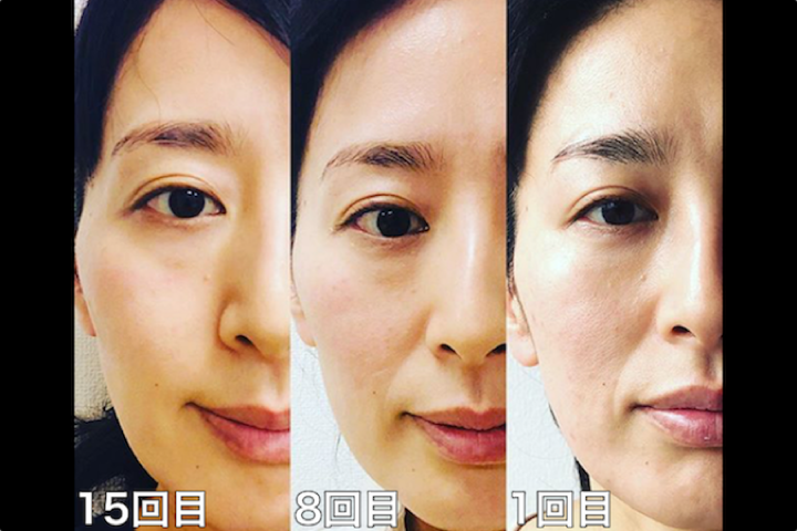 箕面のエステサロンセルラムフェイシャルエステ・ビフォアー/アフターNO.1