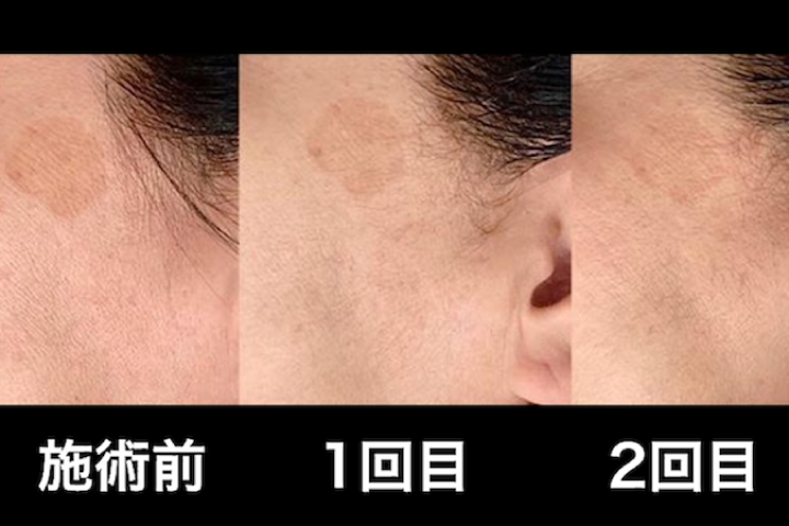 箕面のエステサロンセルラムフェイシャルエステ・ビフォアー/アフターNO.2