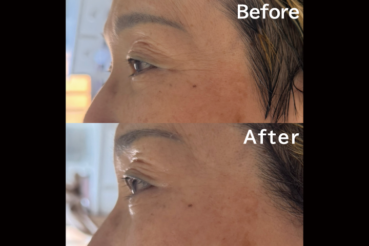 箕面のエステサロンセルラムフェイシャルエステ・ビフォアー/アフターNO.3